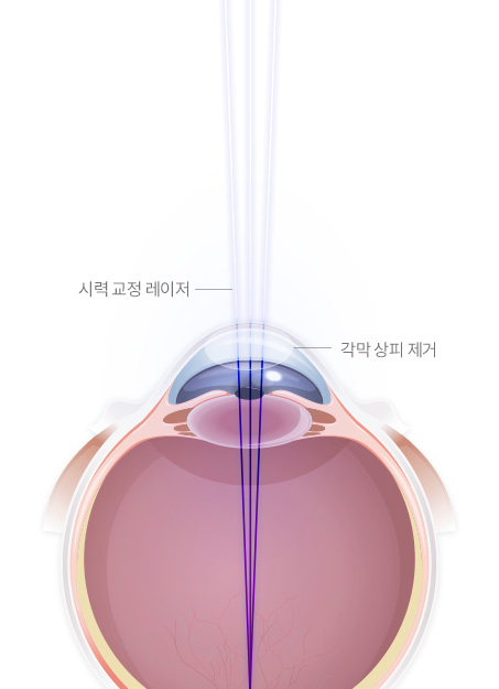 서울연세안과의원 시력교정