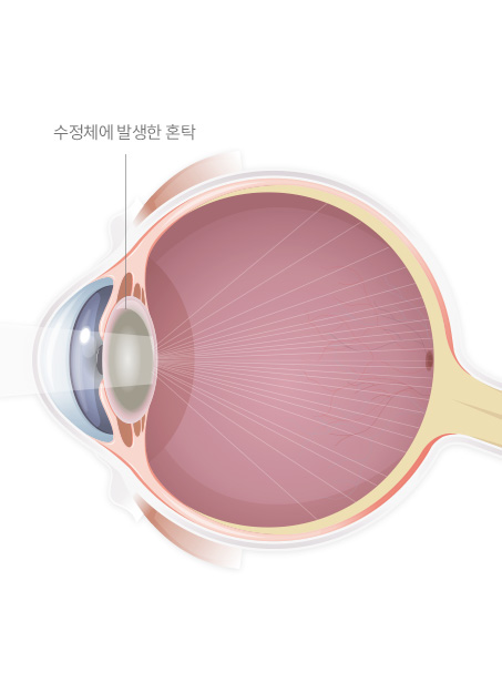 서울연세안과의원 백내장